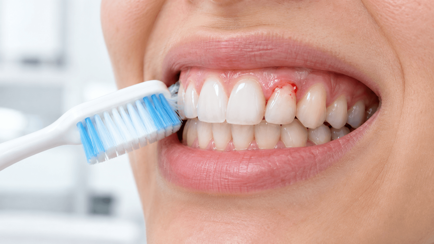 Close-up of mild bleeding gums while brushing