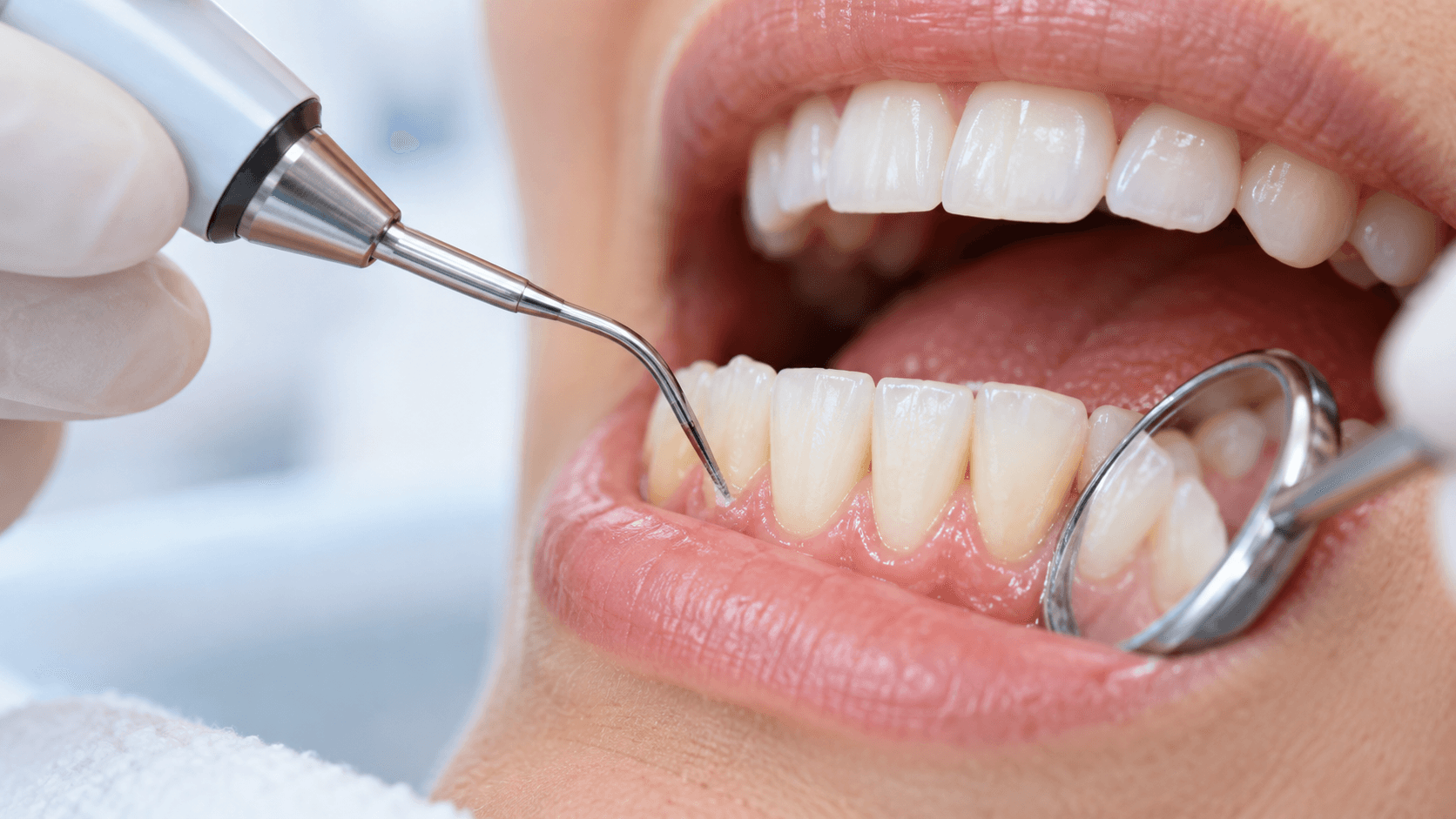 Dental deep cleaning near the gumline