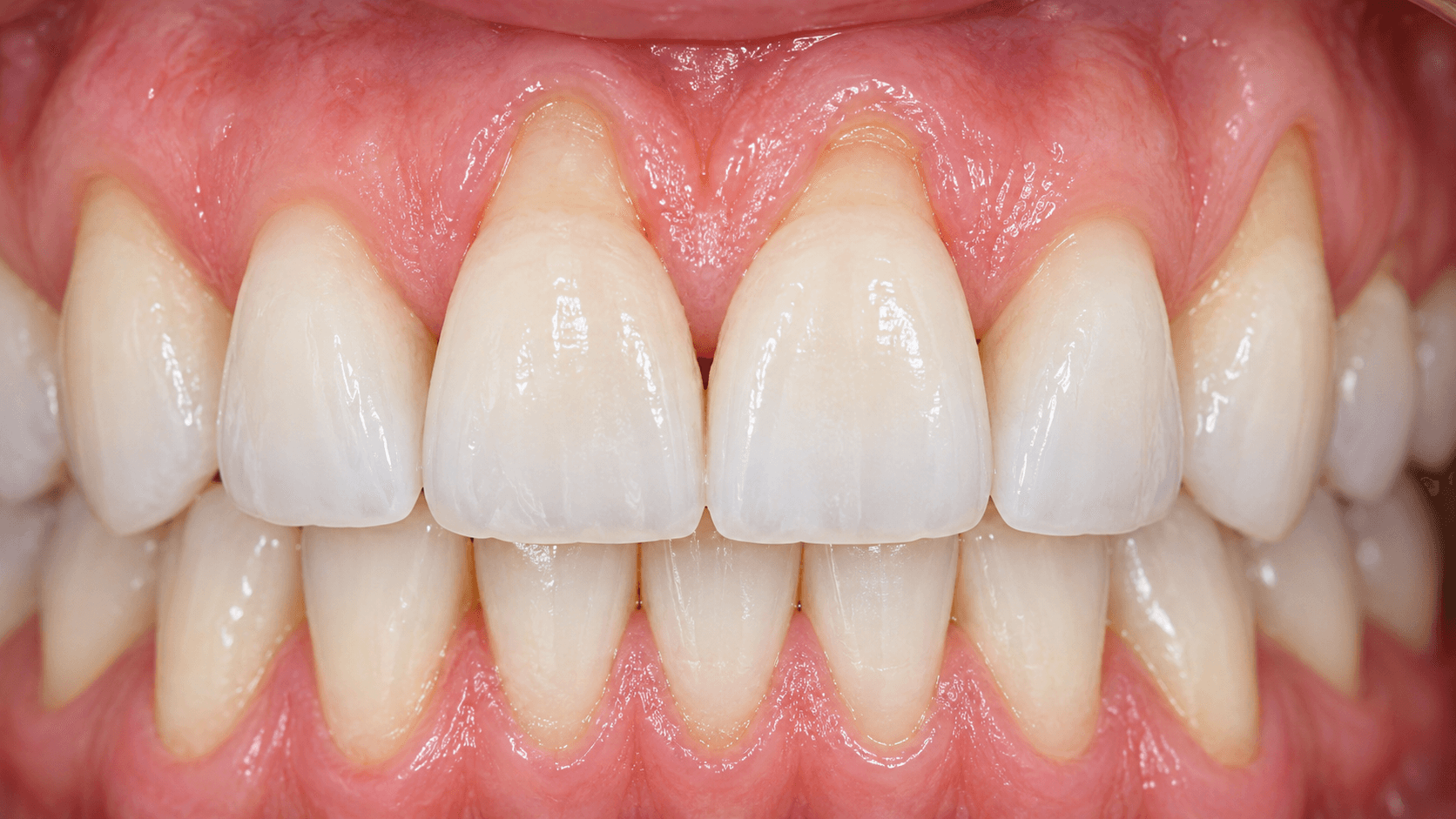Close-up of gum recession around front teeth